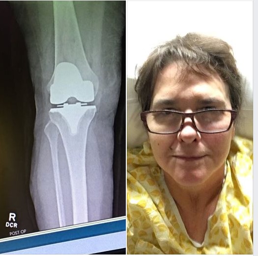 On the left, an X-ray of a titanium knee replacement; on the right, Liz Danforth in a hospital bed selfie.